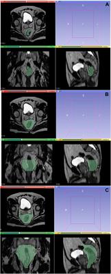 Evaluating complete response prediction rates in locally advanced rectal cancer with different radiomics segmentation approaches